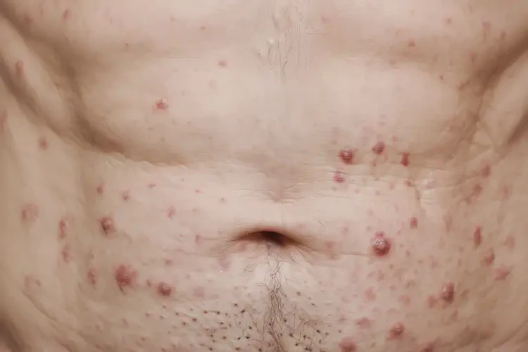 老年人肚子上偶尔起湿疹能彻底自愈吗(图4)