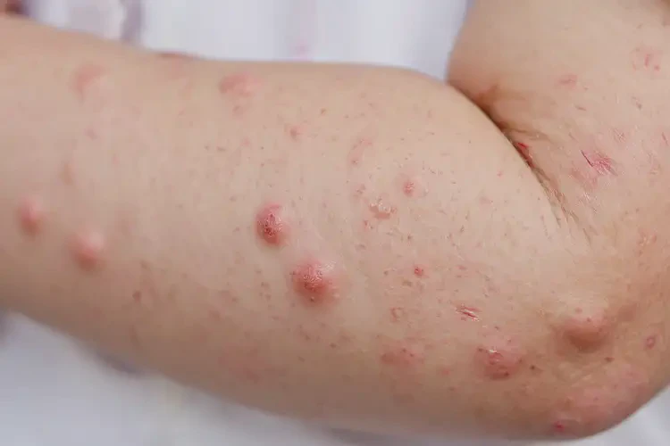 小兒手臂起濕疹能徹底自愈嗎(圖4)