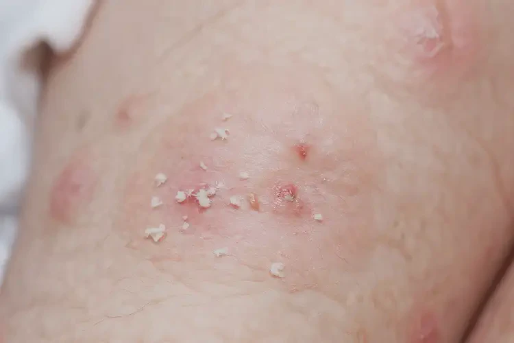 幼兒小腿上有濕疹可不可以徹底自愈(圖4)