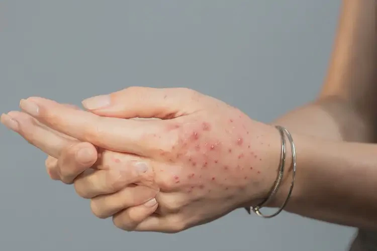 女人手上經(jīng)常長(zhǎng)濕疹能徹底自愈嗎(圖4)