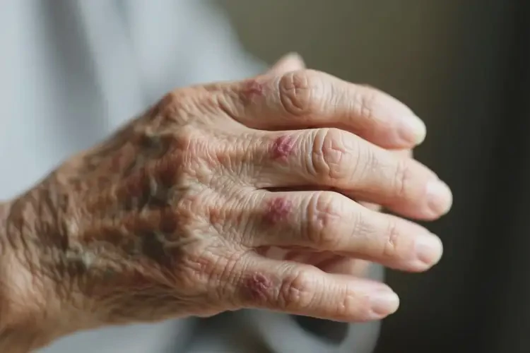 老人身上經(jīng)常起濕疹不管它會(huì)自己痊愈嗎(圖1)