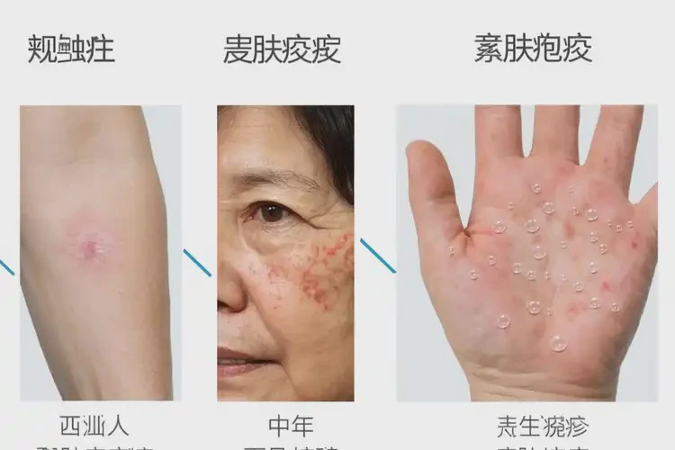 女人肚子偶爾起濕疹可以徹底自愈嗎(圖1)