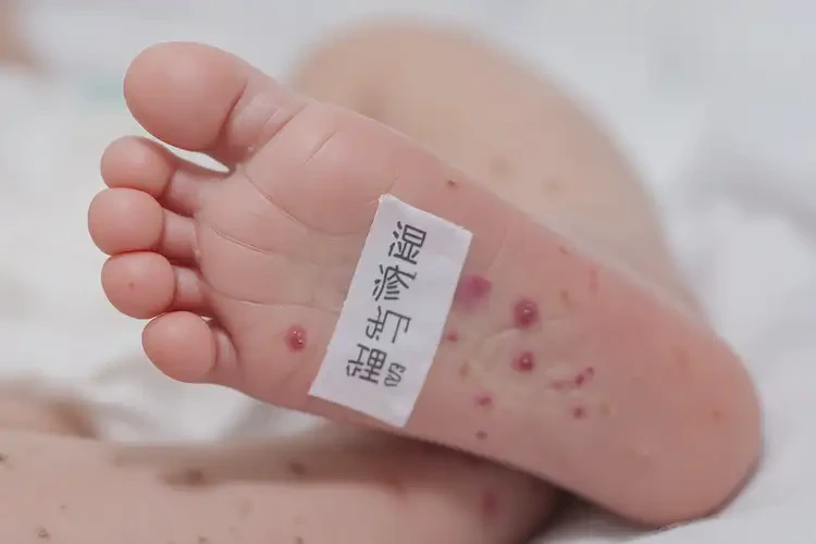 新生兒腳上容易長濕疹能徹底自愈嗎(圖4)