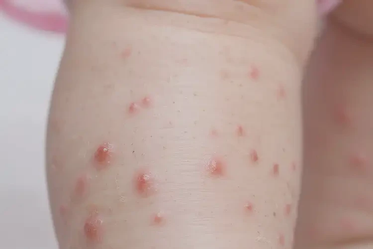 嬰幼兒小腿出現(xiàn)濕疹不管它會自己痊愈嗎(圖4)