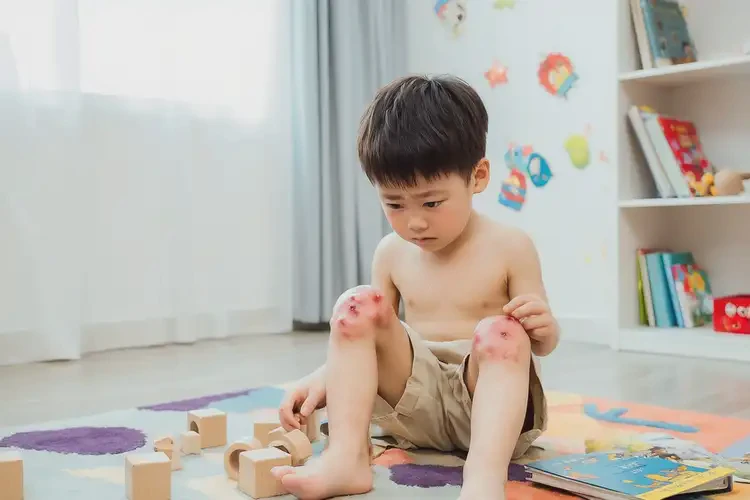 少兒大腿上出現(xiàn)濕疹不管它會(huì)自己好嗎(圖3)