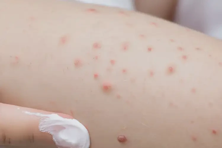 孩子手臂長濕疹可不可以徹底自愈(圖3)