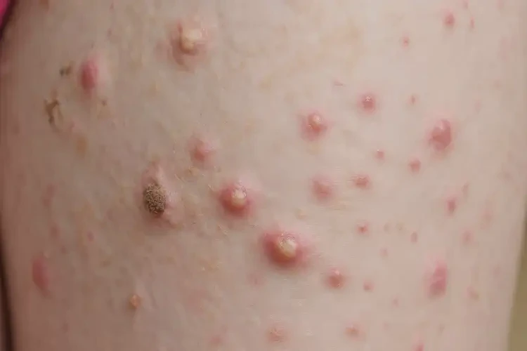 小孩大腿上出濕疹不管它會自己痊愈嗎(圖4)