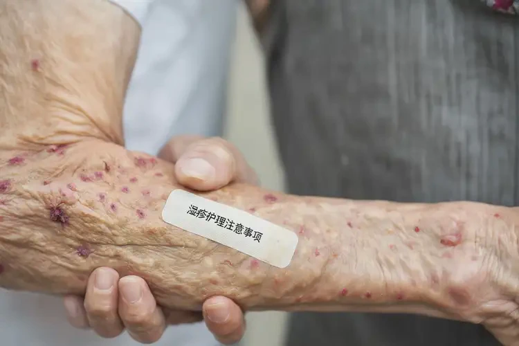 高齡老人手臂上出現(xiàn)濕疹不管它會(huì)自己好嗎(圖4)