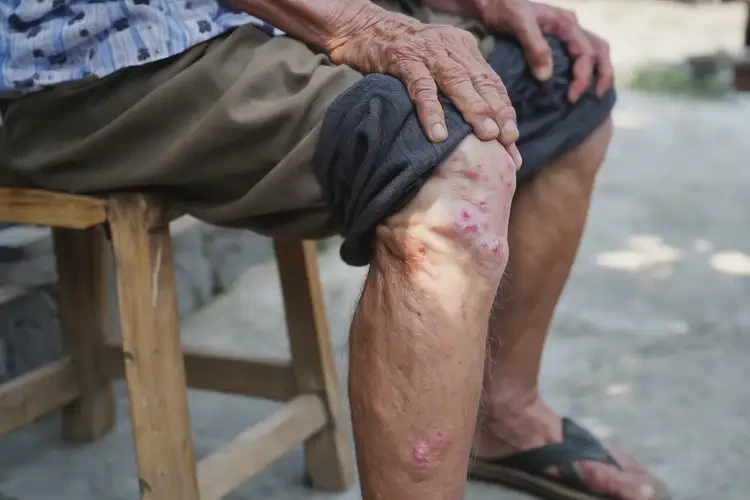 老人小腿上偶爾起濕疹不管它會自己痊愈嗎(圖3)