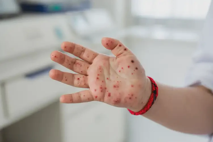 少兒手上經(jīng)常長濕疹不管它會自己自愈嗎(圖4)