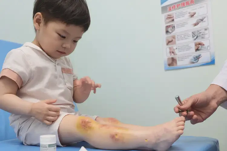 孩子四肢偶爾起濕疹不管它會(huì)自己自愈嗎(圖2)