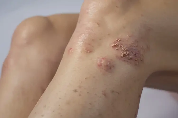 女人小腿上容易起濕疹不管它會自己痊愈嗎(圖4)