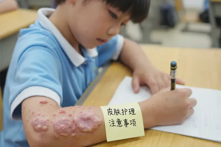 小学生四肢经常起湿疹不管它会自己好吗(图4)