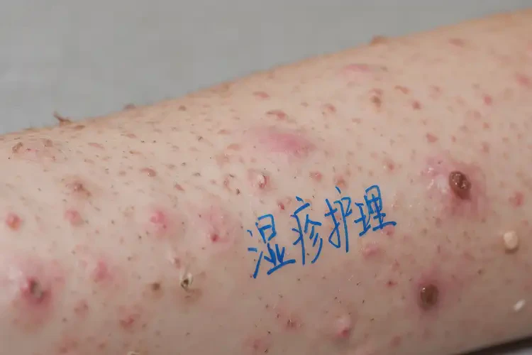 小兒手臂容易起濕疹能夠徹底治愈嗎(圖4)