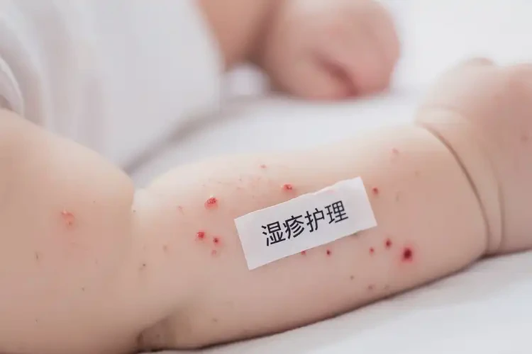宝宝手臂上偶尔长湿疹不管它会自己痊愈吗(图4)