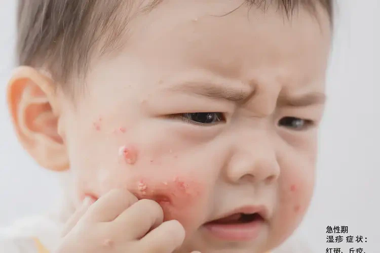 寶寶面部容易長(zhǎng)濕疹可不可以徹底自愈(圖4)