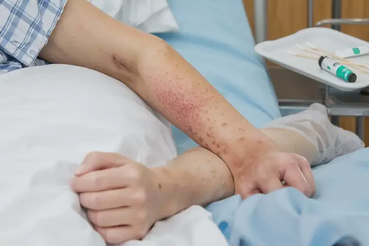 產(chǎn)婦四肢出現(xiàn)濕疹不管它會(huì)自己痊愈嗎(圖4)