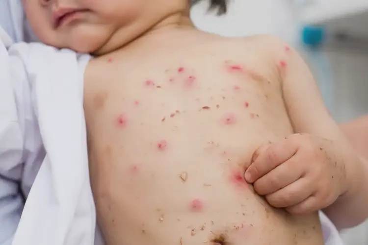 孩子肚子上偶爾起濕疹能夠徹底治愈嗎(圖4)