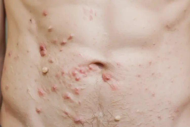 青年人肚子出濕疹不管它會自己痊愈嗎(圖4)