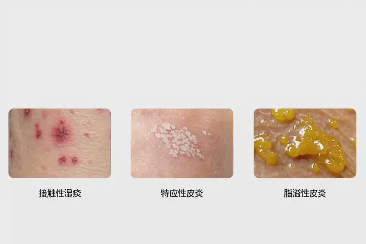 小孩脖子上有濕疹能夠徹底治愈嗎(圖1)