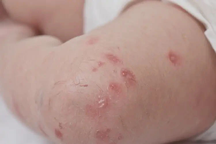 新生兒大腿出現(xiàn)濕疹可不可以徹底自愈(圖3)