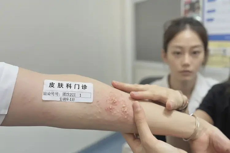 女性手臂偶爾起濕疹不管它會自己好嗎(圖4)