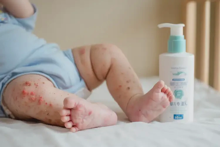 嬰兒小腿上起濕疹能靠自己自愈嗎(圖1)