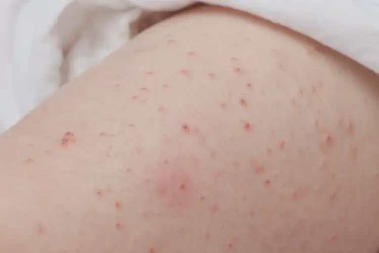 嬰兒大腿上起濕疹可以徹底自愈嗎(圖4)