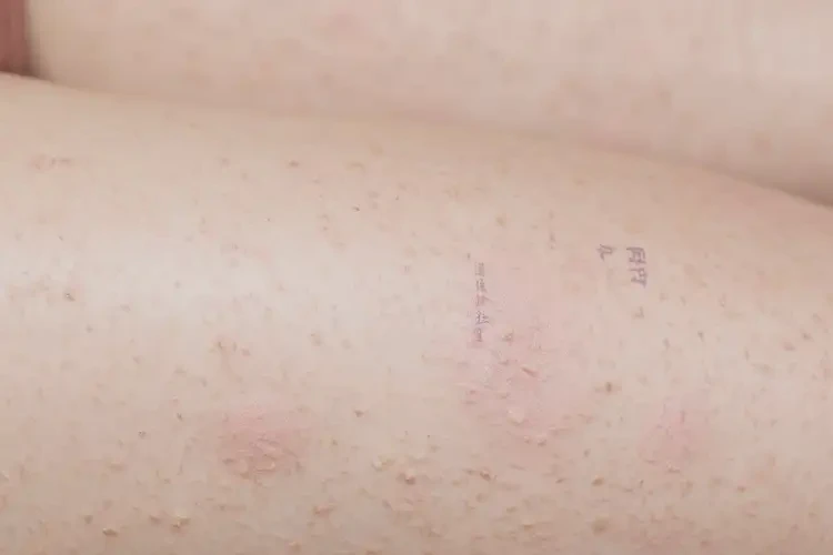 女人大腿上偶爾起濕疹不管它會自己好嗎(圖4)