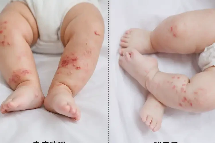 幼兒小腿上有濕疹可不可以徹底自愈(圖2)
