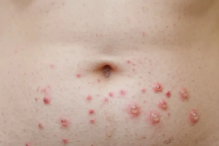 哺乳期媽媽肚子經(jīng)常長濕疹不管它會自己好嗎(圖3)