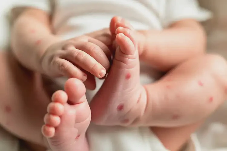 新生兒四肢長(zhǎng)濕疹不管它會(huì)自己痊愈嗎(圖3)