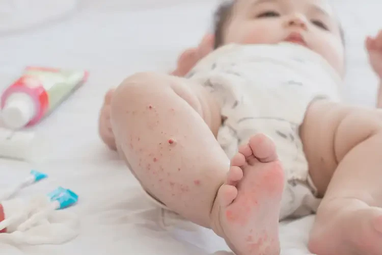 小孩小腿上有濕疹不管它會自己好嗎(圖3)