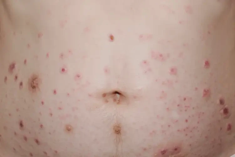 產(chǎn)婦肚子經(jīng)常起濕疹不管它會自己自愈嗎(圖4)