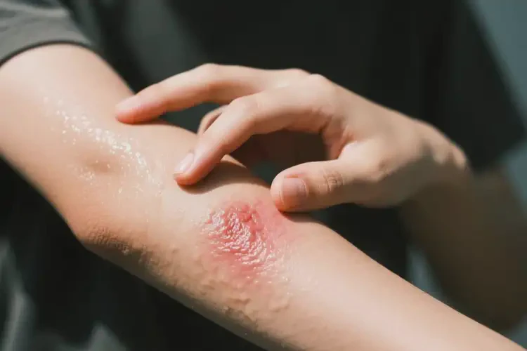 青少年手臂有濕疹可以徹底自愈嗎(圖1)