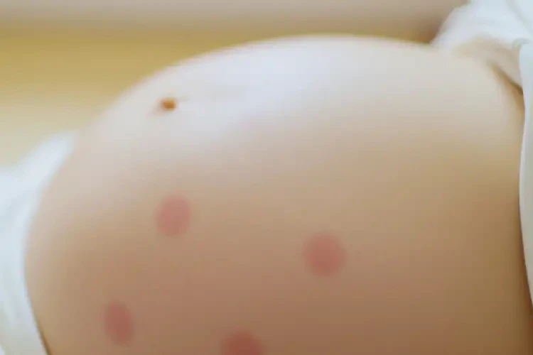產(chǎn)婦肚子上偶爾起濕疹能靠自己自愈嗎(圖4)
