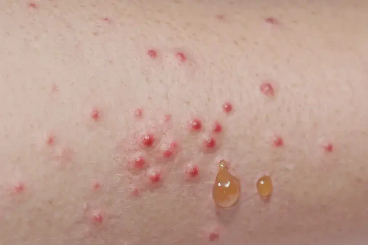 兒童小腿上偶爾起濕疹可以徹底自愈嗎(圖4)