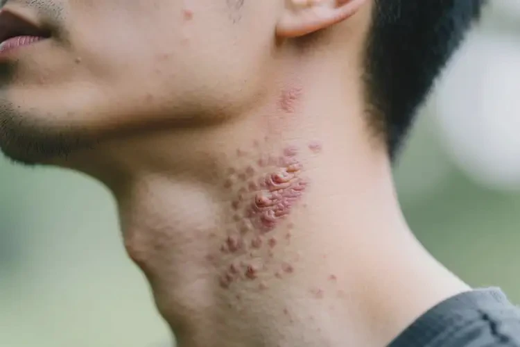 男人脖子容易長濕疹不管它會自己痊愈嗎(圖3)