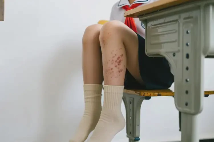 小學(xué)生小腿偶爾長(zhǎng)濕疹能靠自己自愈嗎(圖2)