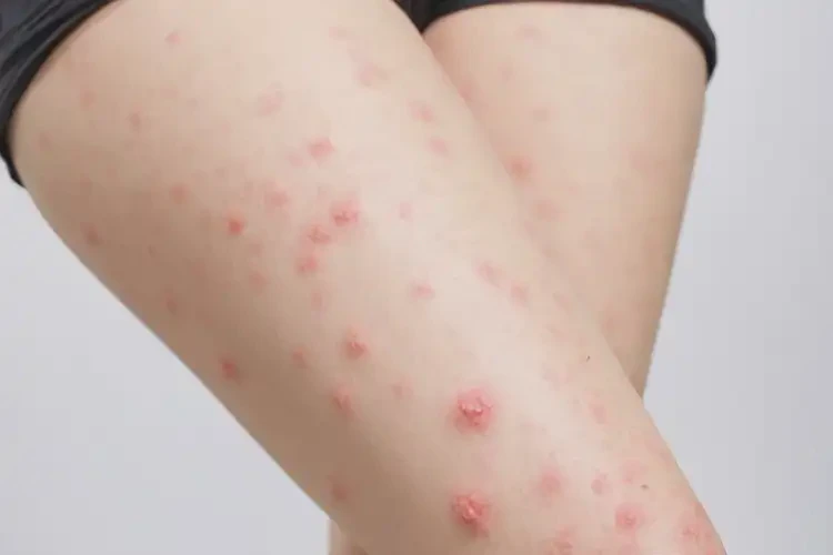 女人大腿上有濕疹不管它會自己好嗎(圖4)