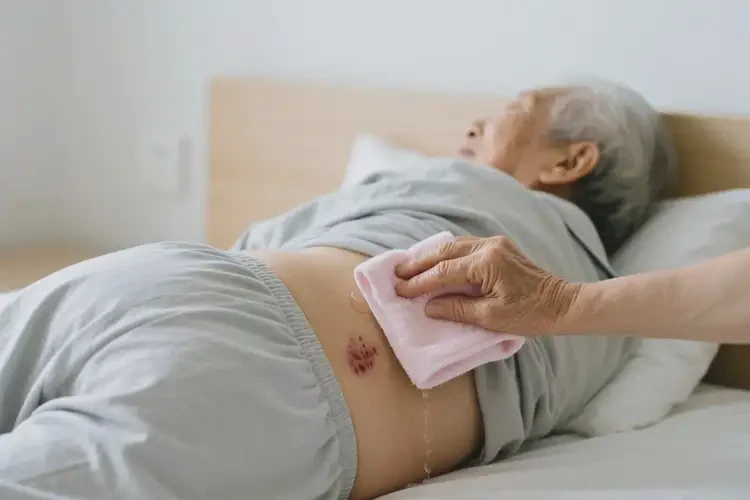 高齡老人屁股偶爾長濕疹不管它會自己自愈嗎(圖3)