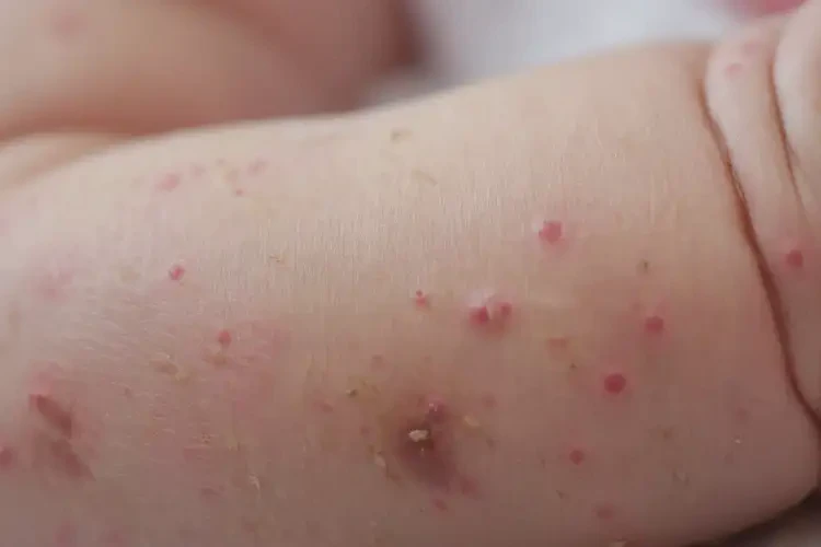 新生兒手臂出濕疹能夠徹底治愈嗎(圖4)