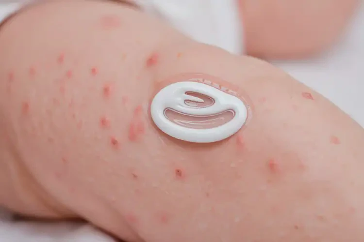 新生儿大腿上出湿疹不管它会自己好吗(图2)