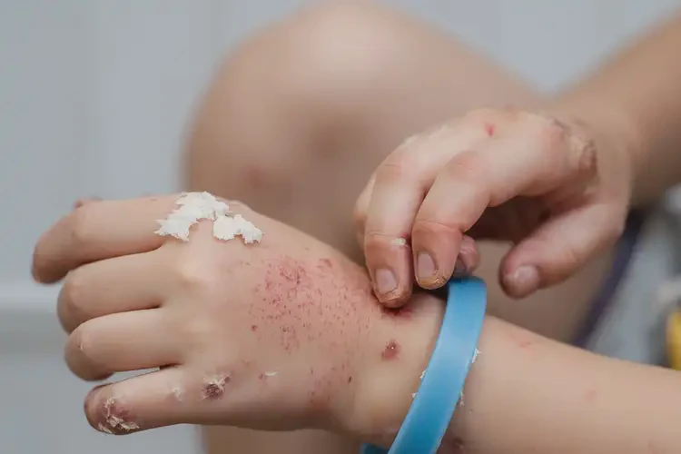 小學生手上容易長濕疹能靠自己自愈嗎(圖4)