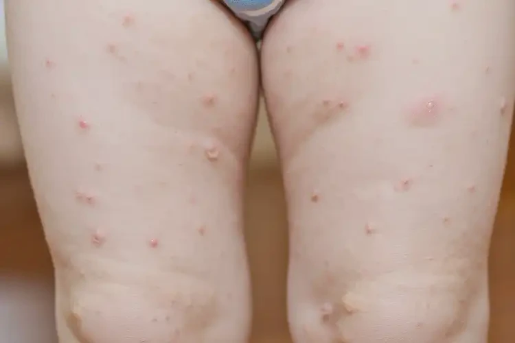 嬰幼兒大腿有濕疹能夠徹底治愈嗎(圖4)