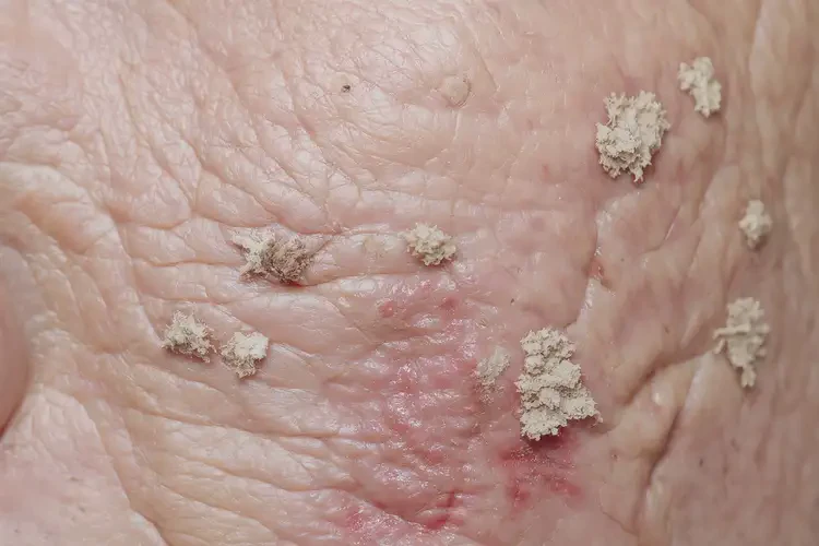 男生脖子長濕疹可不可以徹底自愈(圖2)