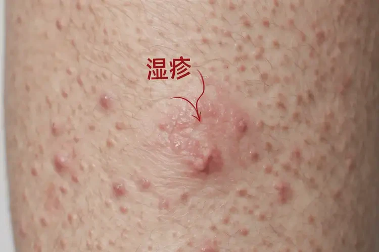 青年人小腿偶爾長濕疹可不可以徹底自愈(圖4)