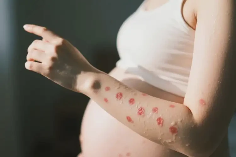 孕婦手臂容易長(zhǎng)濕疹能徹底自愈嗎(圖3)