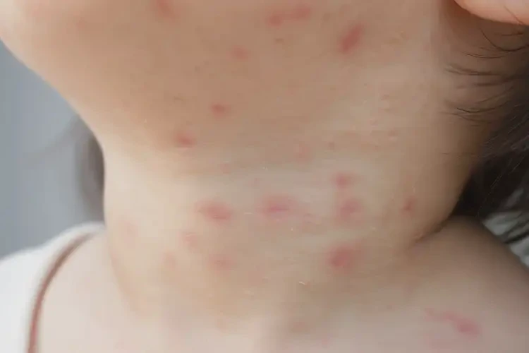 小孩脖子偶爾起濕疹能靠自己自愈嗎(圖4)