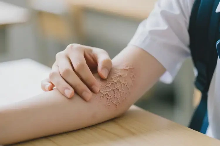 大學(xué)生手臂經(jīng)常長(zhǎng)濕疹不管它會(huì)自己好嗎(圖3)